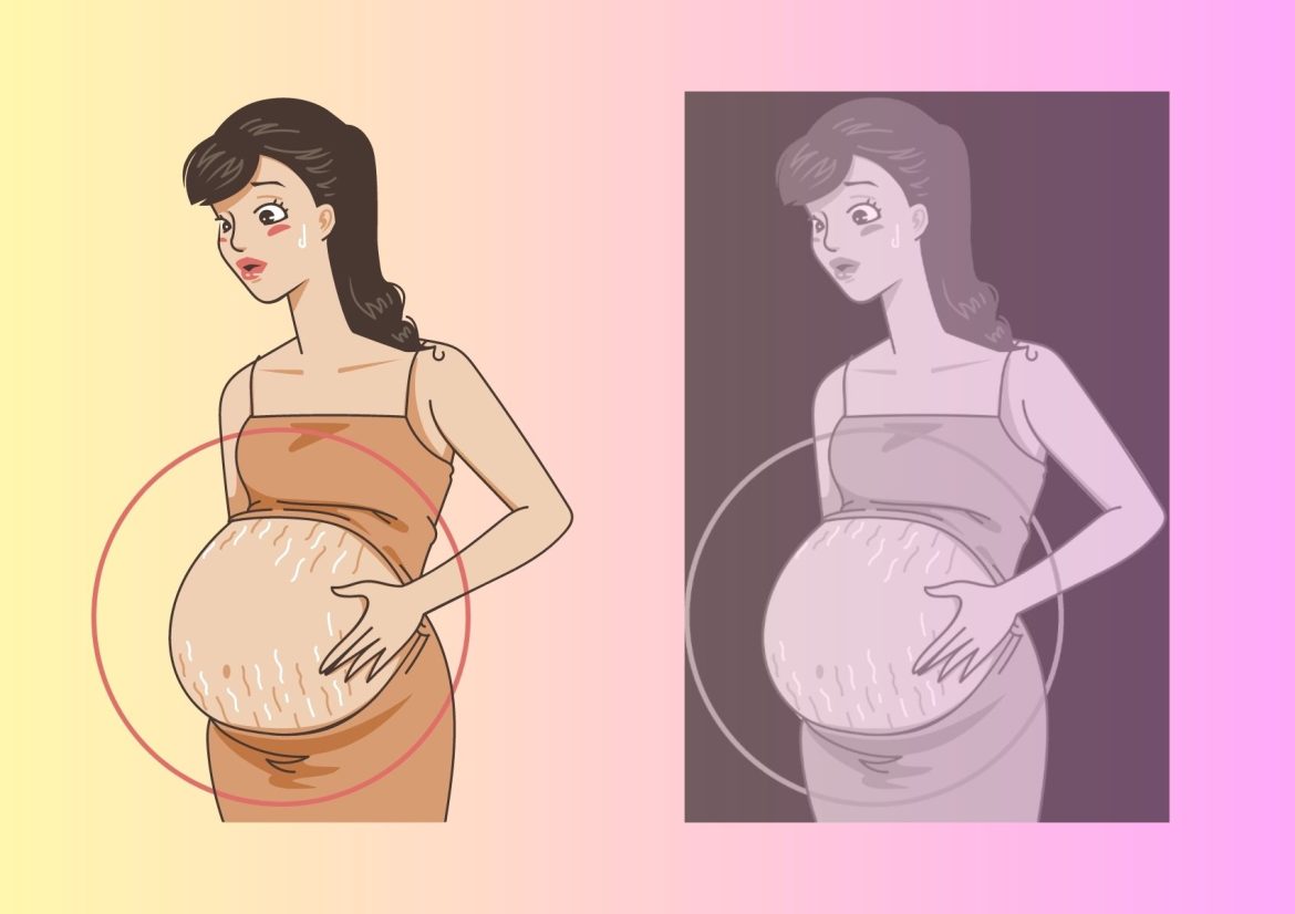 how to prevent pregnancy stretch marks