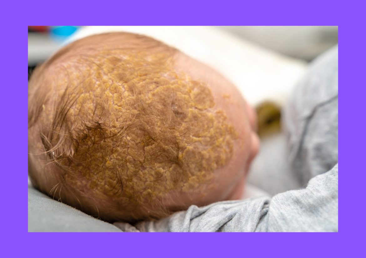 How-to-Get-Rid-of-Cradle-Cap how to get rid of cradle cap fast