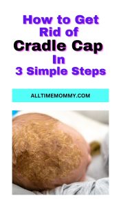 how to get rid of cradle cap fast