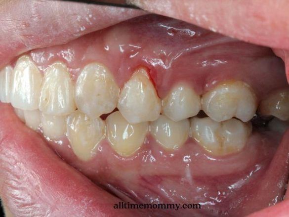 how to fix receding gums