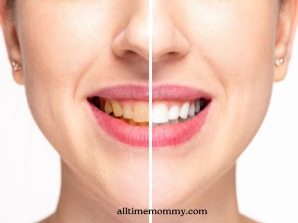 best teeth whitening